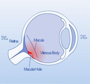 Tear develops in eye tissue